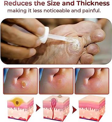 Skin Care Corn Removal Extra Strengthen Gel Foot Callus Treatment