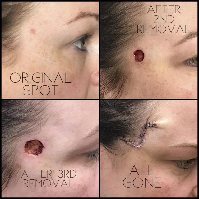 The growth — which left Jones with a hole the size of a nickel on her forehead — was removed and required over 20 stitches to close. (Photo: Caters)