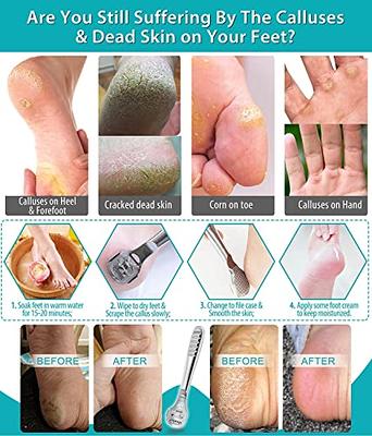 Professional hard skin Foot callus shaver - Foot dead skin remover