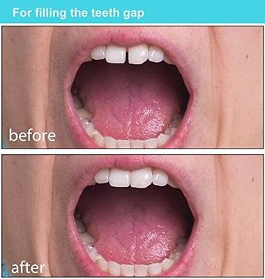 Tooth Repair Kits, Tooth Repair Moldable Fake Teeth, Dental Repair