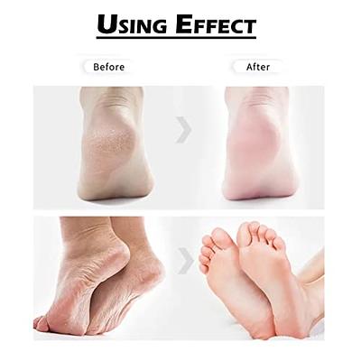 Amope Pedi Perfect Electronic Foot File With 3 New Roller Head Refills