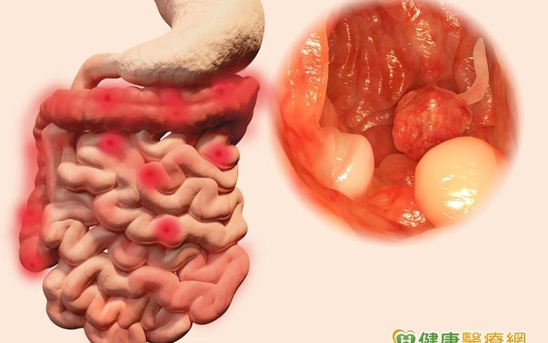 豬哥亮癌末病逝 你該知道的大腸癌防治