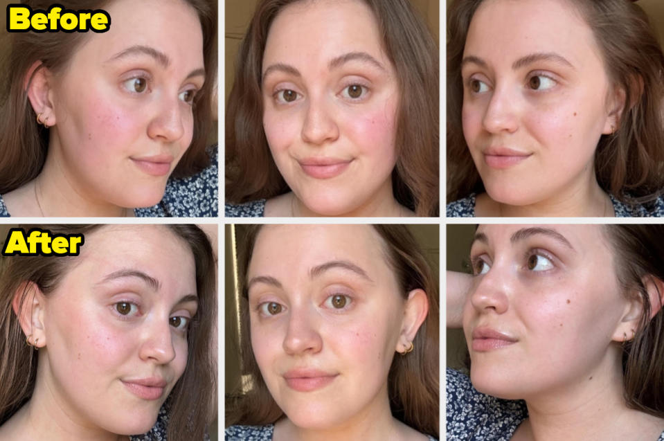 Woman shows before and after skincare results with close-up photos of her face. Before photos on top row, after photos on bottom row