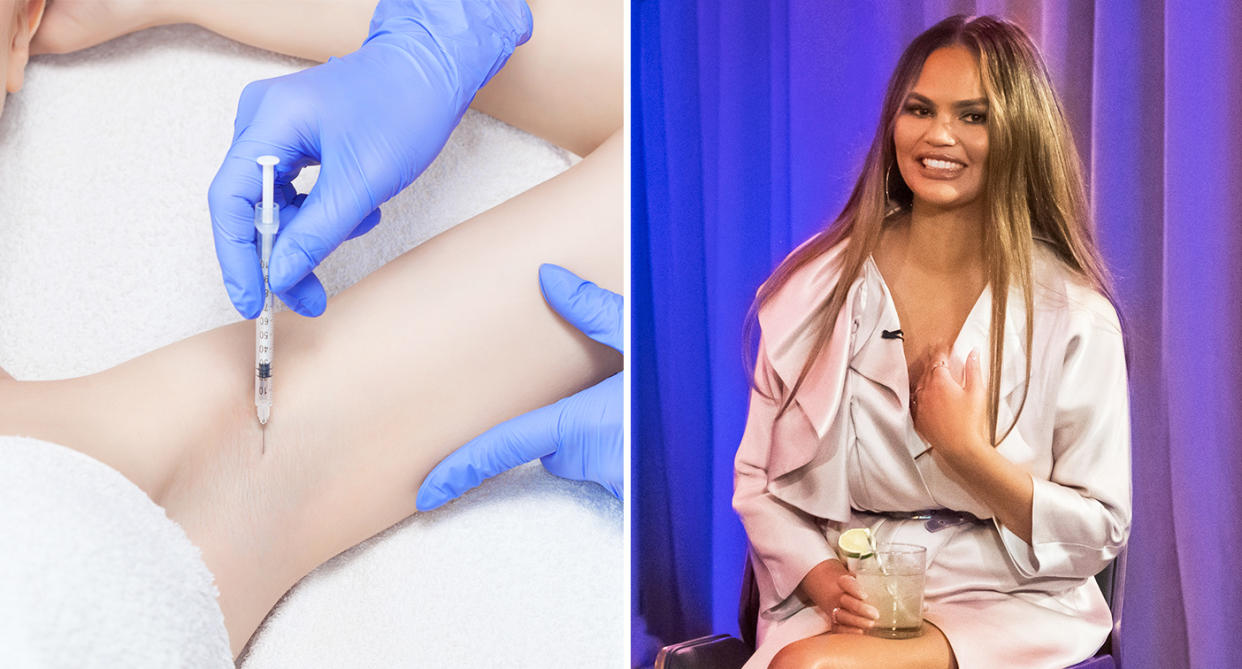 Achsel-Botox: Mit „Spritzen gegen Schwitzen“ wie Chrissy Teigen sie bekommt, könnten Schweißflecken der Vergangenheit angehören. [Foto: Getty]