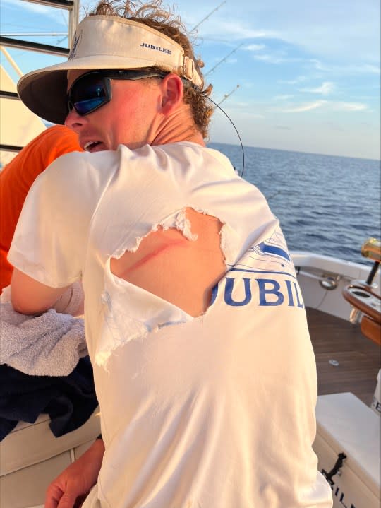 Thomas Arendall after being struck by the blue marlin. (Courtesy of Arendall)