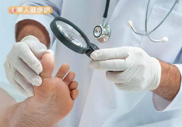 香港腳是由黴菌引起，若輕忽治療，容易引起灰指甲病灶。