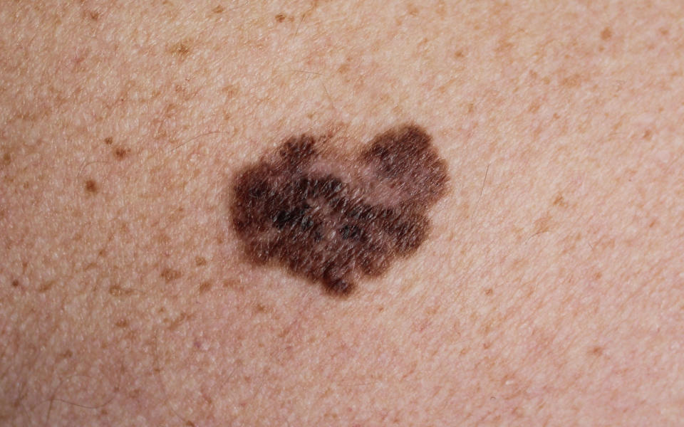 Melanoma - a malignant tumor of the skin (Nasekom / Getty Images / iStockphoto)