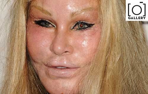 <b>PHOTOS: 11 times plastic surgery went too far</b>