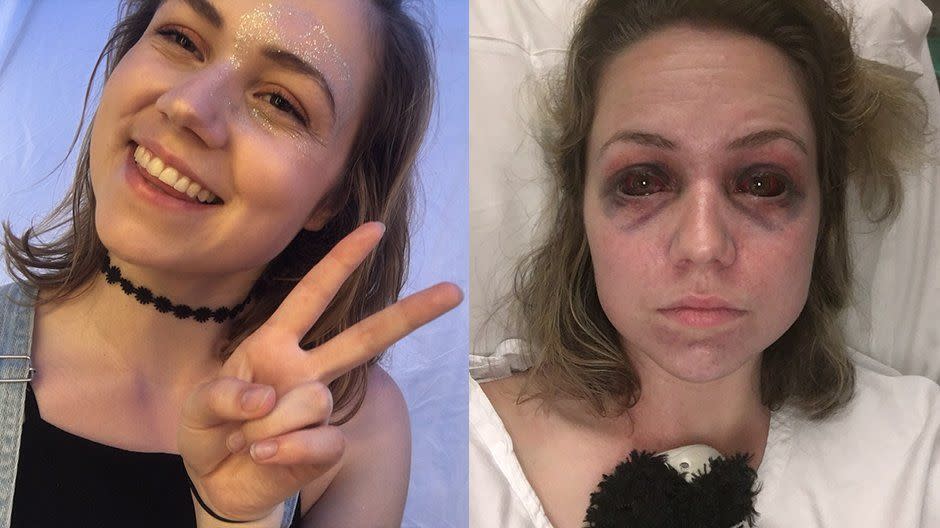 'Mandy', 22, suffered a broken pelvis and horrible black eyes after being crushed at the Falls Festival. Source: Triple J's Hack