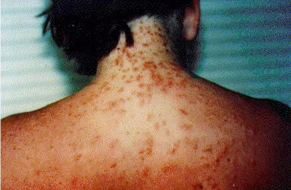 FLORIDA DEPARTMENT OF HEALTH Lesions associated with seabather’s eruption, which is a skin reaction to the larvae of jellyfish and sea anemones. Extended areas of rash may be caused by larvae trapped by clothing or on areas of exposed skin.
