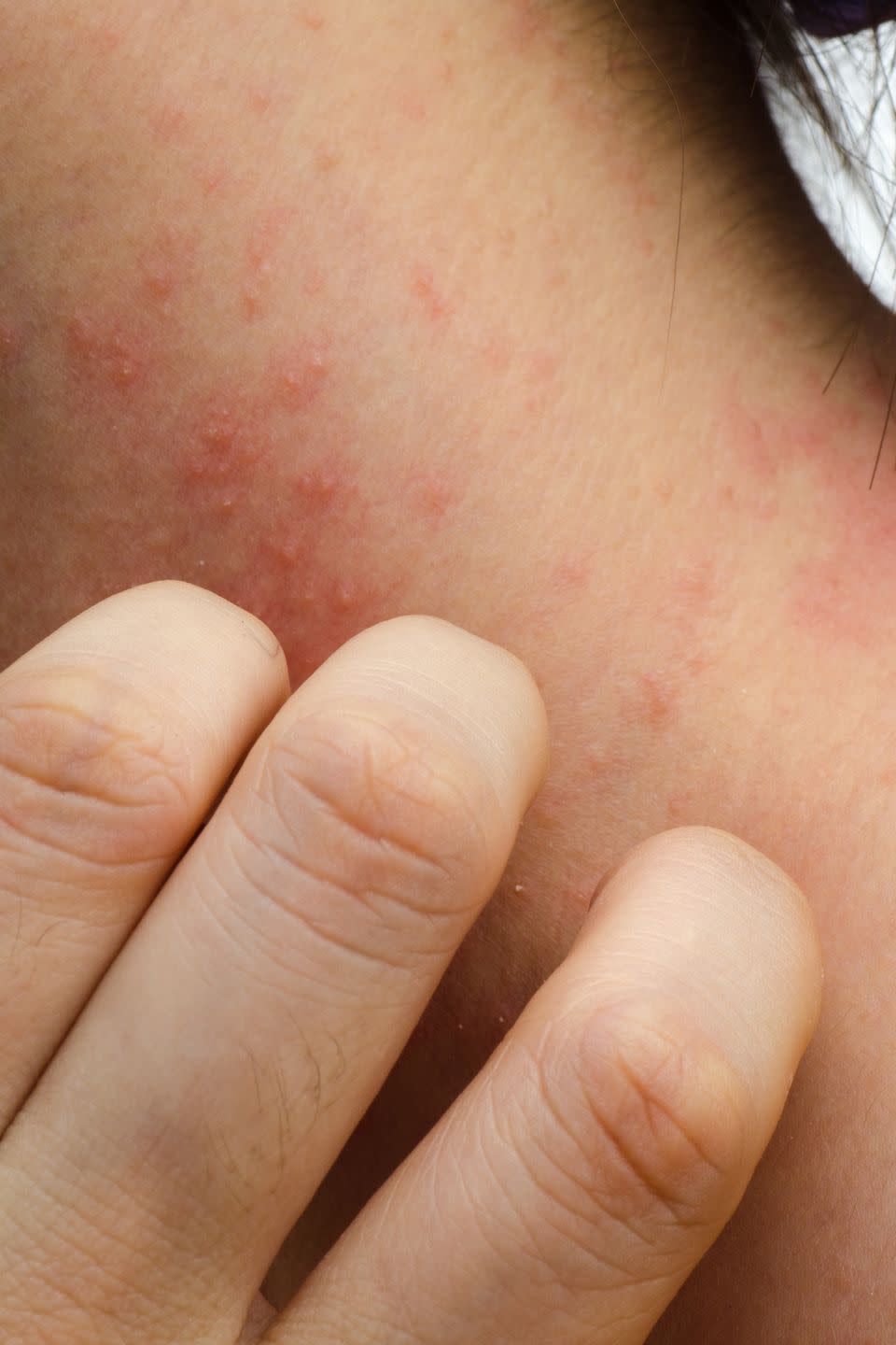 3) Contact Dermatitis: Itchy Redness