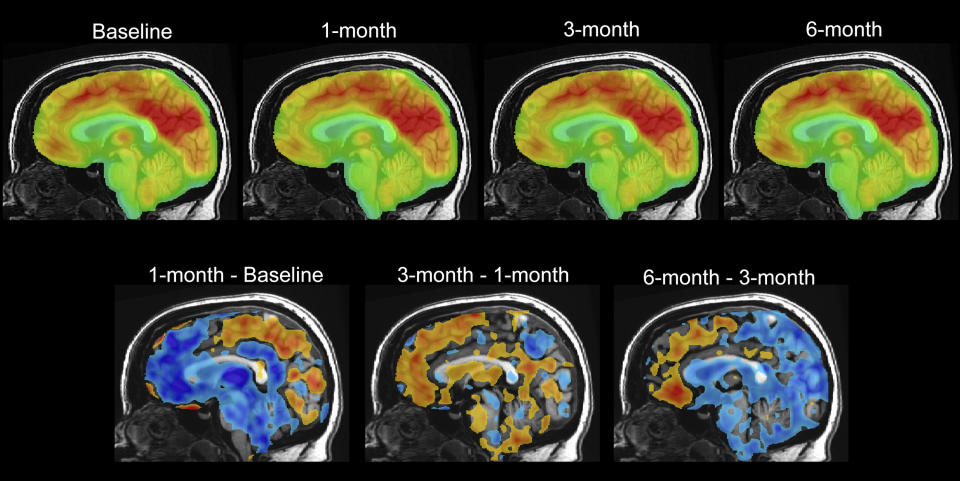 This series of PET brain scan images provided by Mount Sinai in 2024 shows changes in patient Emily Hollenbeck with deep brain stimulation therapy. Analyzing the brain activity of DBS patients, researchers found a unique pattern that reflects the recovery process. (Mount Sinai via AP)