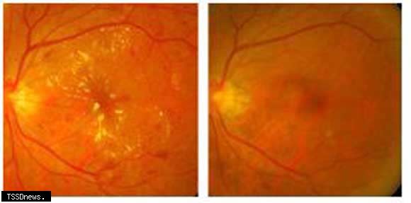 糖尿病黃斑部水腫治療前（左）、後（右）之眼底照片比較，黃斑部黃色滲出物及眼底出血明顯減少。（基隆長庚醫院提供）