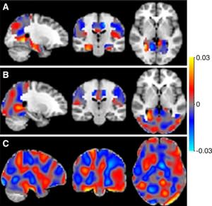 In these brain scans, the classifiers can be represented as discrimination maps, where a red color indicates that the intensity at that location contributes to the likelihood of the images belonging to the mor