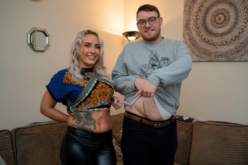 Lloyd and Kira reveal their surgery scars. (Kira Owen/SWNS)