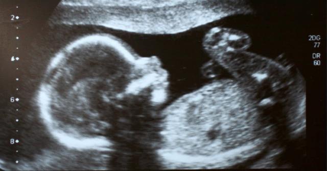 Can a baby fart in the womb?