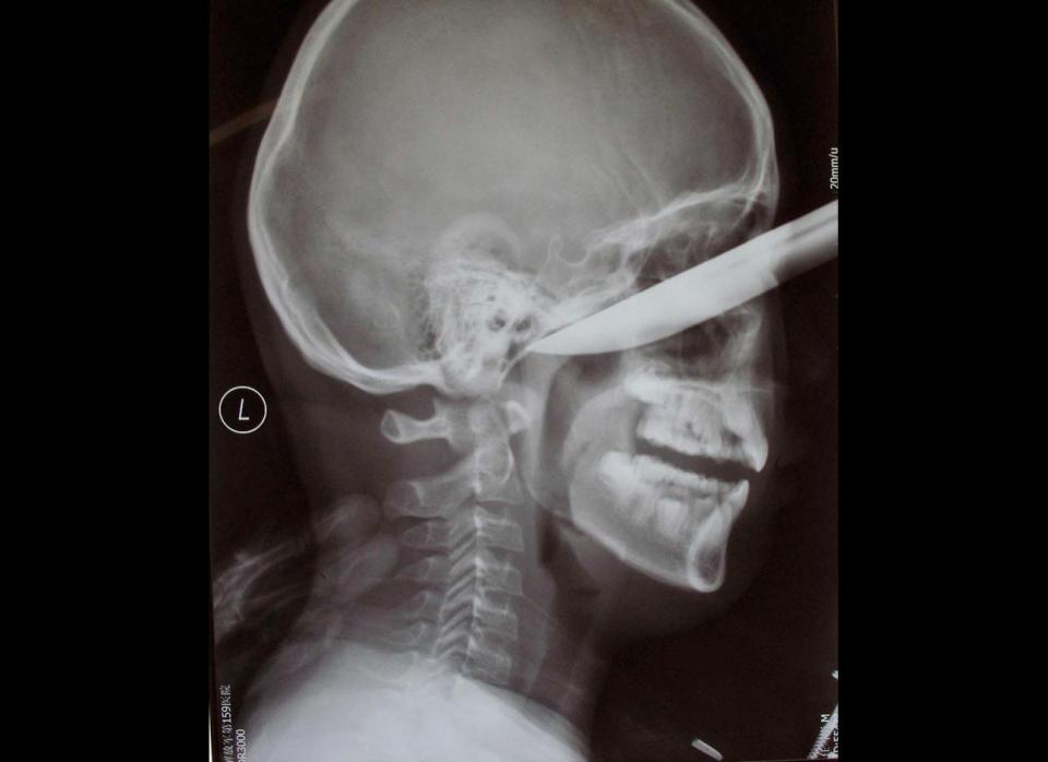 A stunning X-ray image shows a knife stuck deep inside a Chinese teenager's cheek. Ren Hanzhi, 13, tripped and fell while peeling an apple -- jamming himself in the face with a nearly 8-inch knife on Jan. 31. Amazingly, the blade did not strike the boy's brain and doctors were able to remove the knife, expecting him to make a full recovery. 