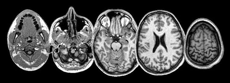 <span class="caption">Research based on MRI images usually exclude the skull.</span> <span class="attribution"><span class="source">Wikimedia Commons.</span>, <a class="link " href="http://creativecommons.org/licenses/by-sa/4.0/" rel="nofollow noopener" target="_blank" data-ylk="slk:CC BY-SA;elm:context_link;itc:0;sec:content-canvas">CC BY-SA</a></span>