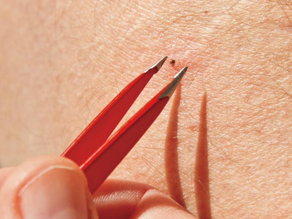 tweezers tick bite