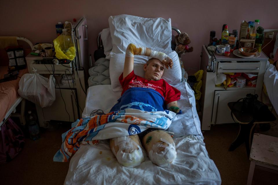 Anton Gladun, 22, lies on his bed at the Third City Hospital, in Cherkasy, Ukraine, on May 5, 2022. Gladun, a military medic deployed on the front lines in eastern Ukraine, lost both legs and his left arm in a mine explosion on March 27. Photographer Emilio Morenatti, Associated Press, was awarded a honourable mention in the Europe category of the World Press Photo Contest.
