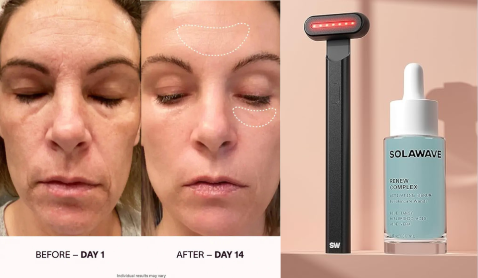 before and after image of woman's face after using the Solawave for 14 days / black Solawave wand and bottle of Solawave Renew Complex Serum