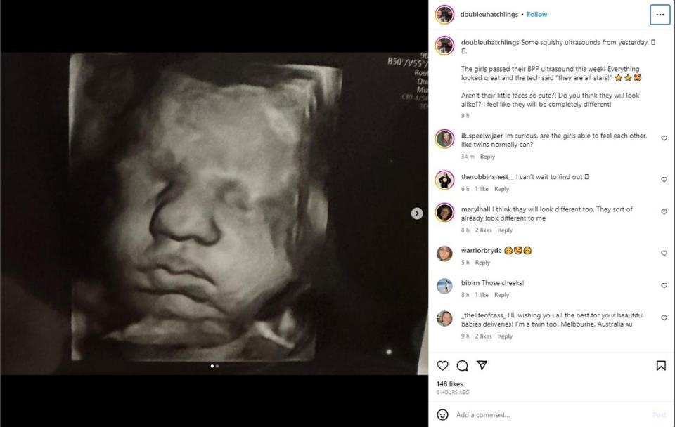 Kelsey Hatcher documents her extremely rare case of having two uteruses and being pregnant in both on Instagram (Instagram/Kelsey Hatcher/@doubleuhatchlings)