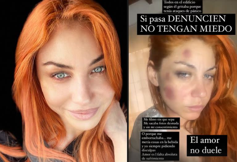 Lourdes Fernández, de Bandana, acusó a su expareja de golpearla