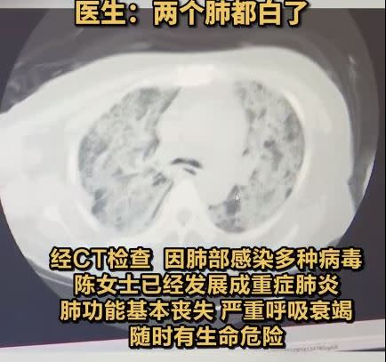 醫生透露，阿嬤目前肺功能基本喪失、嚴重呼吸衰竭，隨時有生命危險。（圖／翻攝自《荔枝新聞》微博）