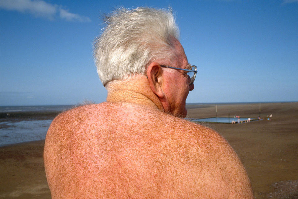 old guy melanoma