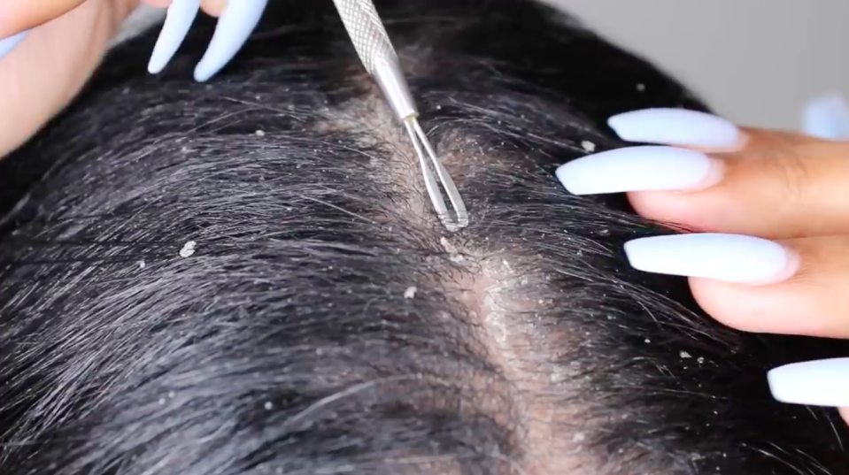 Dandruff scraping is the new pimple popping [Photo: YouTube]