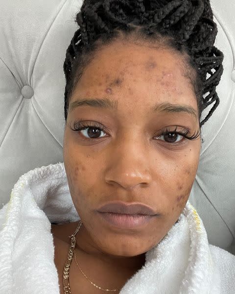 <p>Keke Palmer took to Instagram to post an emotional selfie that showed the actress without make-up on, and revealing her acne scars as a result of PCOS. The 27-year-old discussed her experience of living with Poly Cystic Ovarian Syndrome and her struggles with discovering the real cause of her acne after undergoing two rounds of prescribed Accutane medication with no results. </p><p>With her hair back in braids, Palmer looked natural and stunning, acne scars included. 'My skin has made me sad many nights but I do not give up on myself. I know this is not me and my body has been looking for help,' she told her 10.1 million Instagram followers.</p><p><a href="https://www.instagram.com/p/CIRMIqODTtF/" rel="nofollow noopener" target="_blank" data-ylk="slk:See the original post on Instagram;elm:context_link;itc:0;sec:content-canvas" class="link ">See the original post on Instagram</a></p>