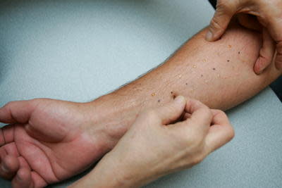 Eisenhower Health offers allergy testing at its Allergy and Immunology Clinic.