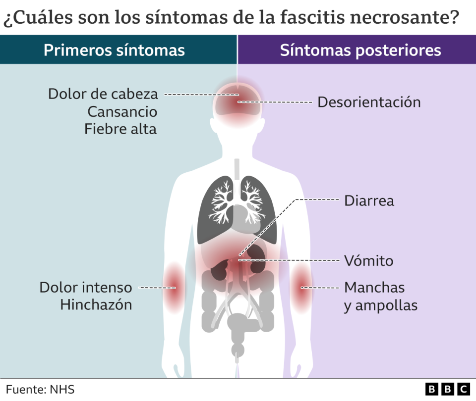 Síntomas de la fascitis necrosante.