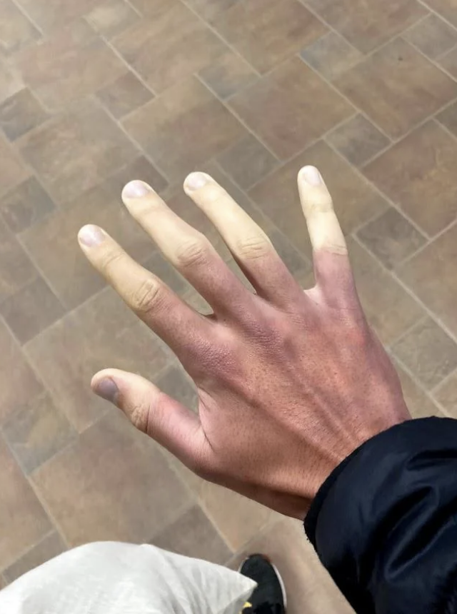 A hand displaying a medical condition where the fingers are discolored, with the tips appearing pale and the rest of the hand a darker shade