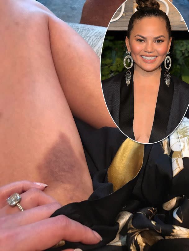 They don't call it Lip Sync BATTLE for nothing! The show's commentator took to Instagram to reveal a huge dark bruise on her inner thigh after performing a stunt while filming the show. "I now do stunts #lipsyncbattlescar #iflew!" she captioned the photo on April 4, 2017.