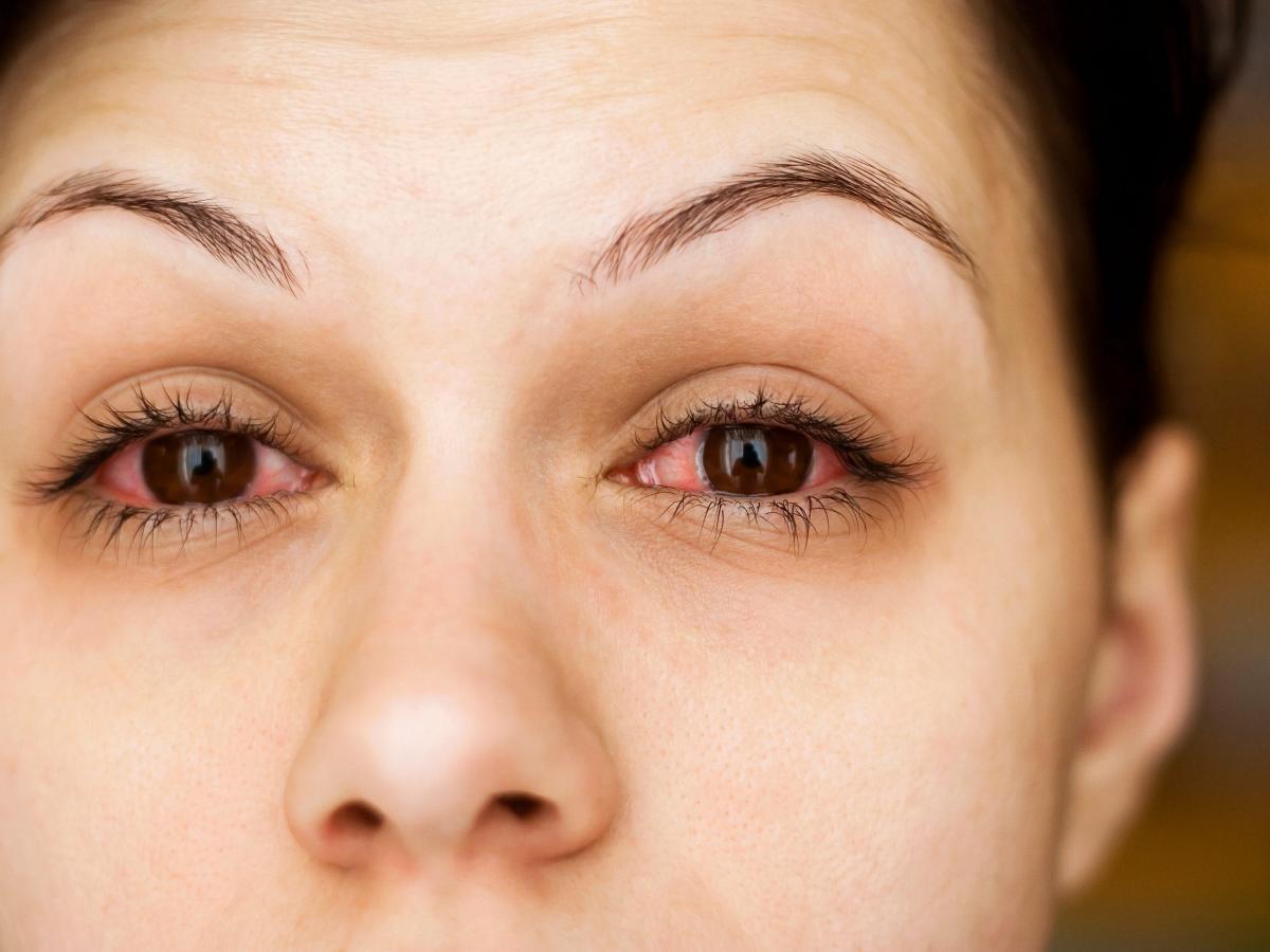 Do You Have Viral Or Bacterial Pink Eye How To Tell The Difference And Get Proper Treatment 