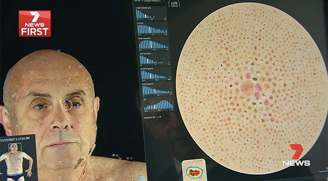 A 'Wagon Wheel' maps moles and lesions from smallest to largest. Source: 7 News