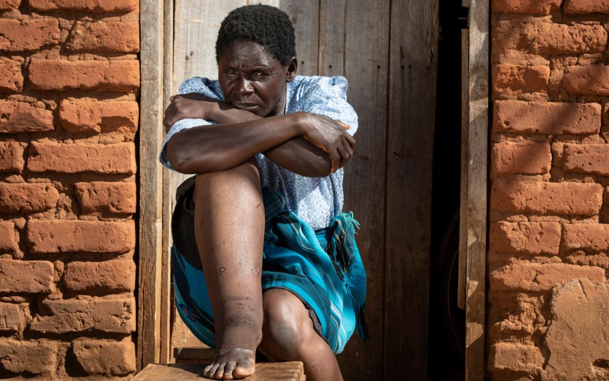 Loveness Pitala, 48, suffers from the NTD elephantiasis, which causes severe swelling - © 2019 Simon Townsley Ltd