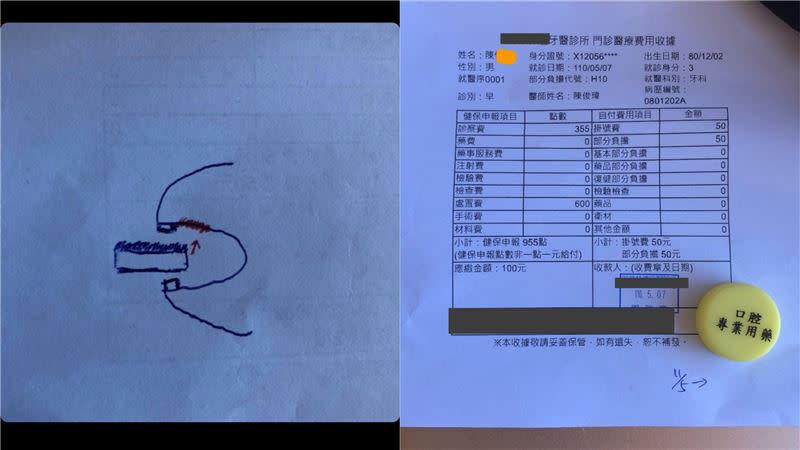 男子上顎被花生後面燙傷，手繪示意，求診時醫生也驚訝。（圖／當事人提供）