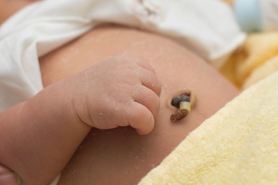 Once the umbilical cord is cut, the stump dries up and falls off, revealing the baby’s navel. <a href="https://www.gettyimages.com/detail/photo/close-up-umbilical-cord-royalty-free-image/525032060" rel="nofollow noopener" target="_blank" data-ylk="slk:Wacharaphong/iStock via Getty Images Plus;elm:context_link;itc:0;sec:content-canvas" class="link ">Wacharaphong/iStock via Getty Images Plus</a>