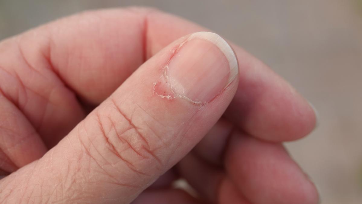 Est-il dangereux d'arracher les peaux autour des ongles ?