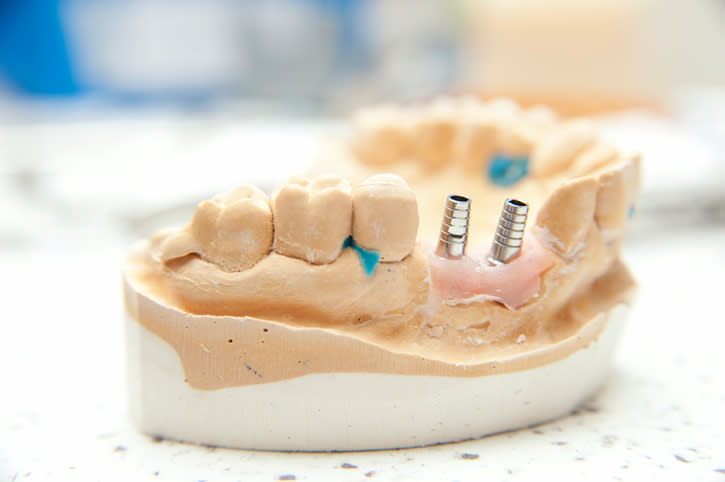 Hay muchas “leyendas” que se cuentan sobre los implantes dentales. Foto: gmutlu/Getty Images