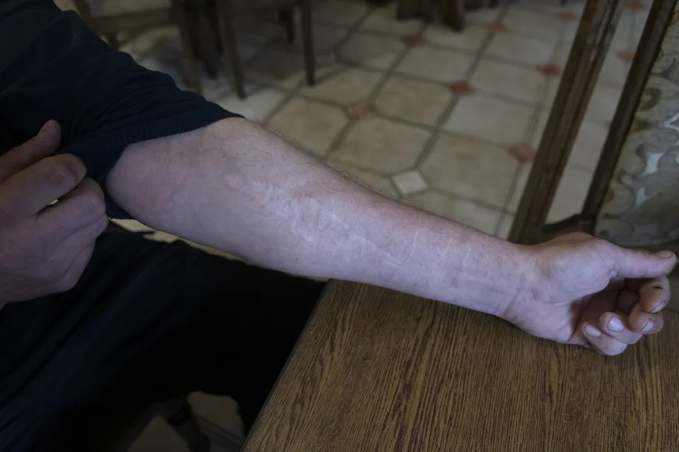 42-year-old Vyacheslav Ryabkov, an internally displaced person from Kozachi Laheri in the Kherson region of Ukraine, shows in Kolomyya on Feb. 13, 2024 the scars on his arms caused by Russian soldiers who cut him with a knife. Russia has successfully imposed its passports on nearly the entire population of occupied Ukraine by making it impossible to survive without them, coercing hundreds of thousands of people into citizenship. (AP Photo/Vasilisa Stepanenko)