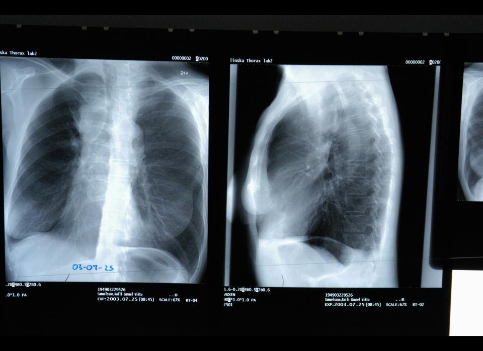 The risk of bankruptcy for someone with lung cancer five years after diagnosis is 7.7 percent.