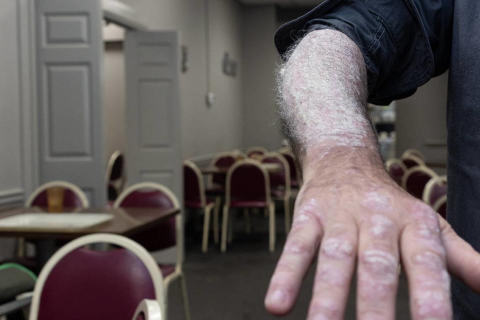 Larry Burgan shows where burns on his arms were that he said he received from radioactive dust falling on him while working at the Venice-Madison site when it was owned by Spectrulite Consortium Inc. “It never healed,” Burgan said, “and that’s the kind of stuff we worked around every day.”