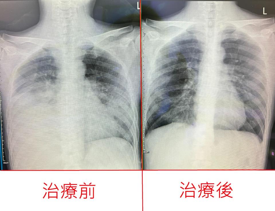 東山鴨頭楊老闆的肺部，治療前是兩側白肺(圖左)，治療後(圖右)已經明顯改善。烏日林新醫院提供