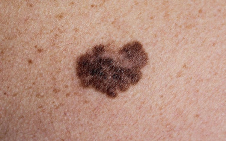 A picture of an irregular mole, which is a sign of melanoma.