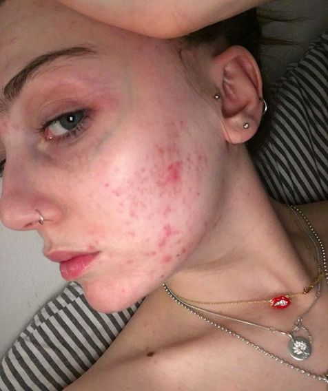 Under the hashtag #FreeThePimple, Louisa Northcote wants to break taboos around acne. (Photo: Instagram/louisanorthcote)