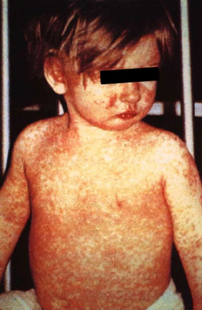 A photo provided by the Centers for Disease Control and Prevention shows a child with a classic measles rash after four days