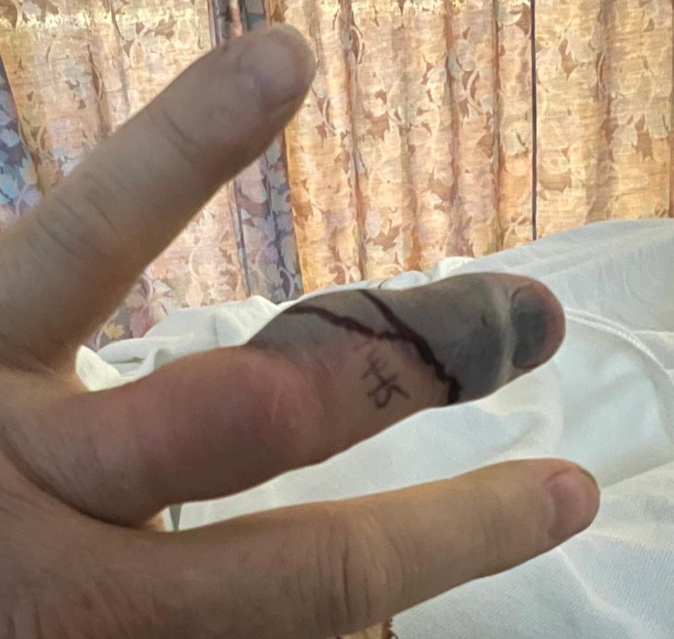 Cary Elwes’ finger after rattlesnake bite (Twitter/Cary Elwes)